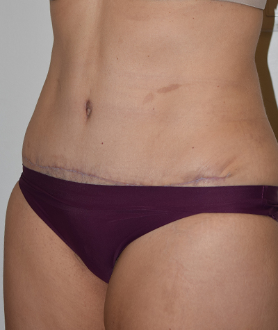 Tummy Tuck Before and After 10