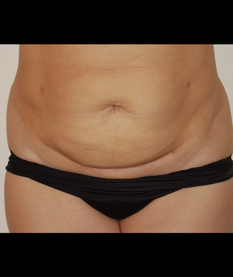 Tummy Tuck Before and After 11