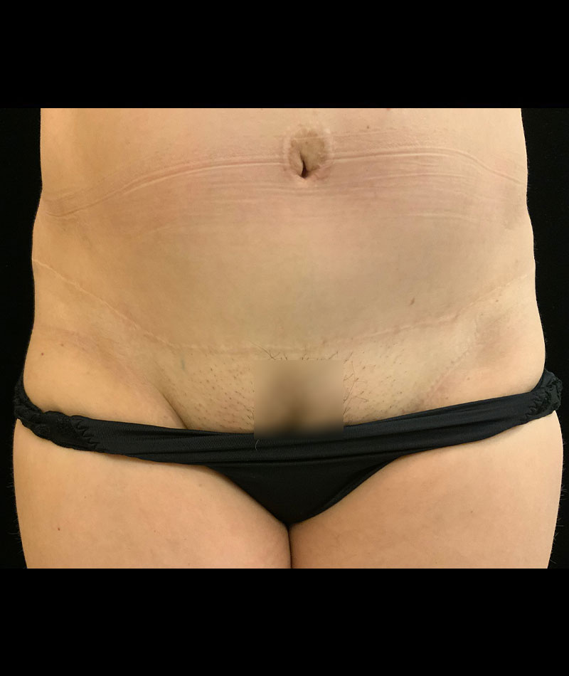 Tummy Tuck Before and After 06