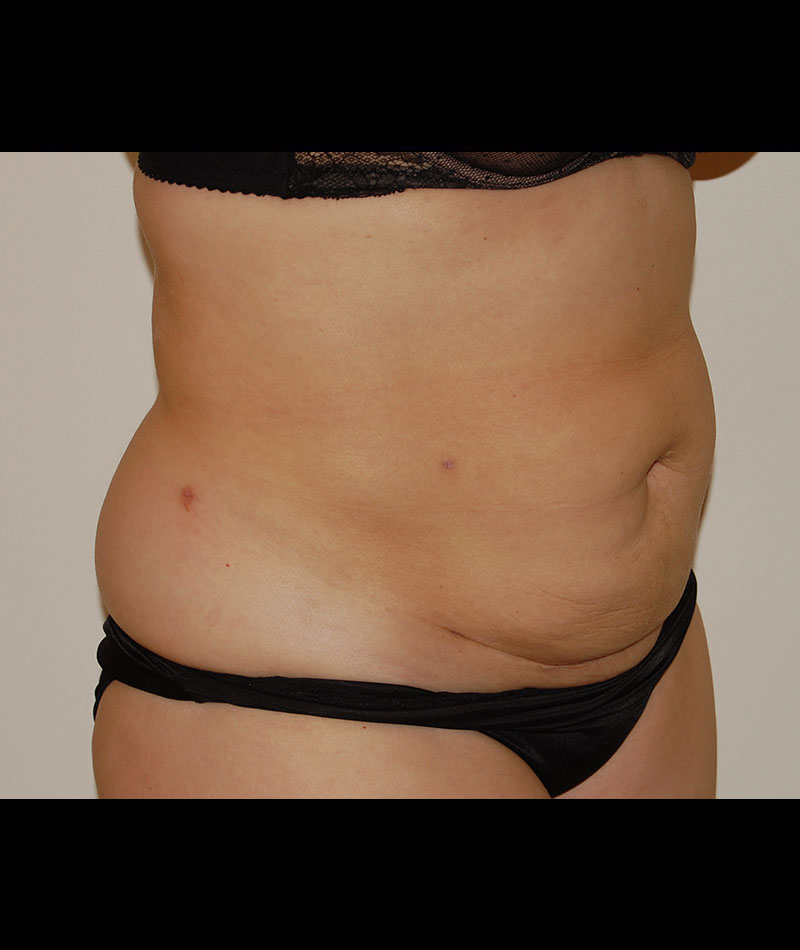 Tummy Tuck Before and After 11