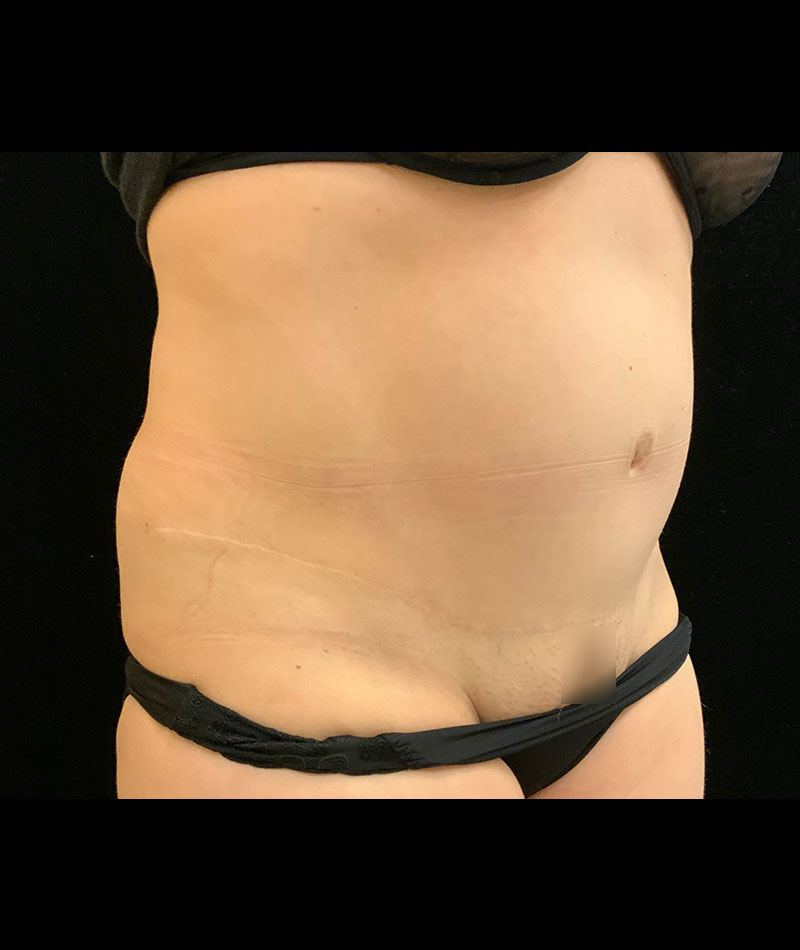 Tummy Tuck Before and After 11