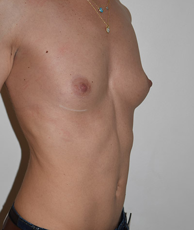 Breast Augmentation Before and After 01