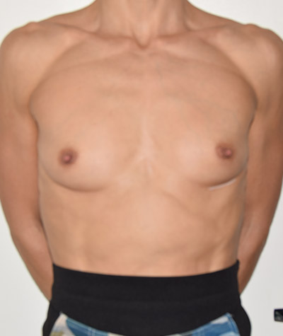 Breast Augmentation Before and After 02