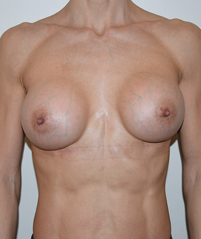 Breast Augmentation Before and After 31
