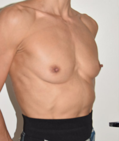 Breast Augmentation Before and After 02