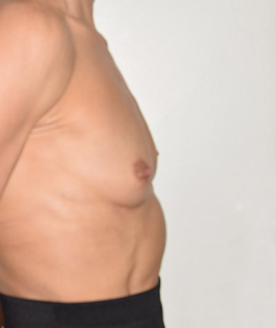 Breast Augmentation Before and After 02