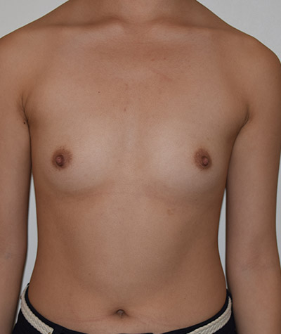 Breast Augmentation Before and After 04