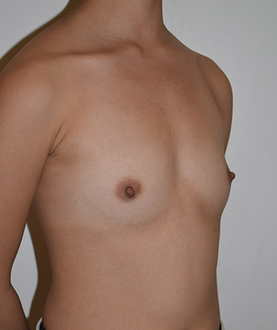 Breast Augmentation Before and After 04