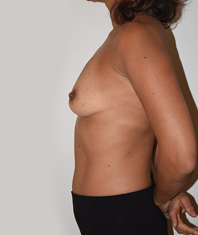 Breast Augmentation Before and After 05