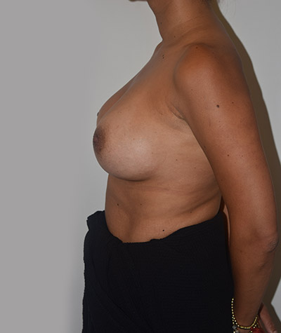 Breast Augmentation Before and After 05