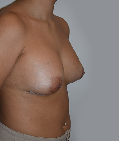 Breast Augmentation Before and After 06