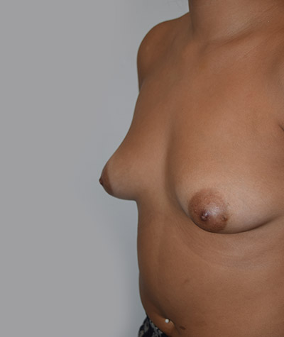 Breast Augmentation Before and After 06