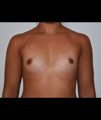Breast Augmentation Before and After 09