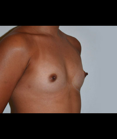 Breast Augmentation Before and After 09