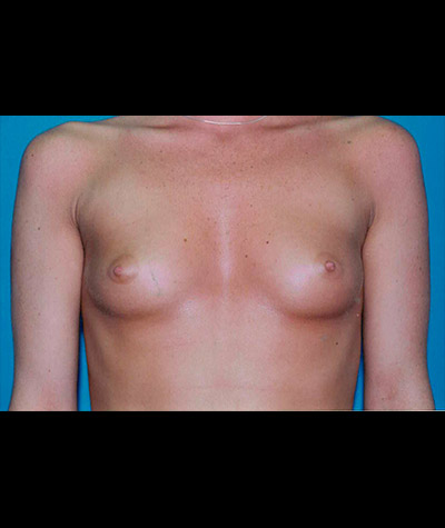 Breast Augmentation Before and After 11