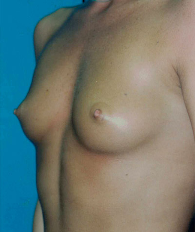 Breast Augmentation Before and After 11