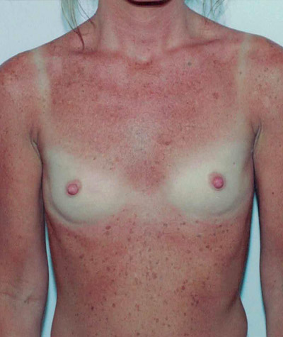 Breast Augmentation Before and After 14
