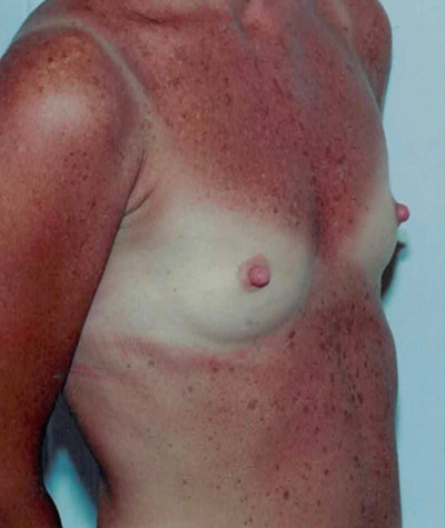 Breast Augmentation Before and After 14