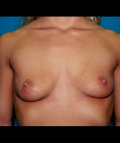 Breast Augmentation Before and After 15