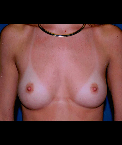 Breast Augmentation Before and After 16