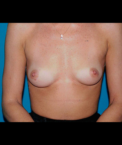 Breast Augmentation Before and After 17