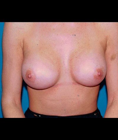 Breast Augmentation Before and After 31