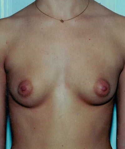Breast Augmentation Before and After 19