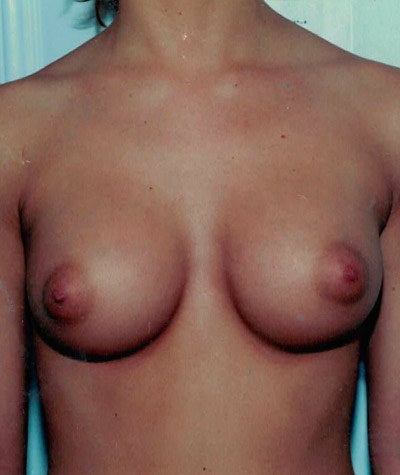 Breast Augmentation Before and After 31