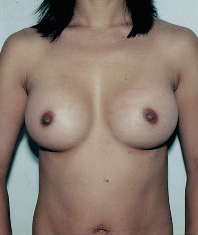 Breast Augmentation Before and After 31