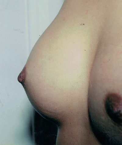 Breast Augmentation Before and After 21