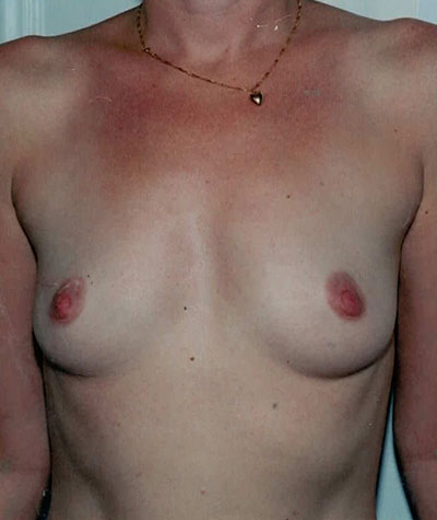 Breast Augmentation Before and After 23