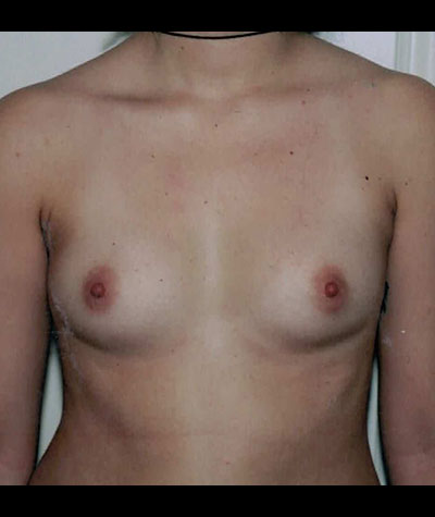 Breast Augmentation Before and After 25
