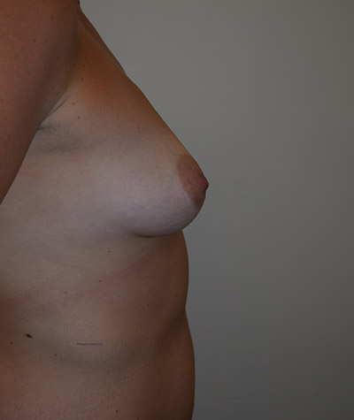 Breast Augmentation Before and After 26