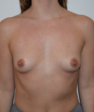 Breast Augmentation Before and After 28