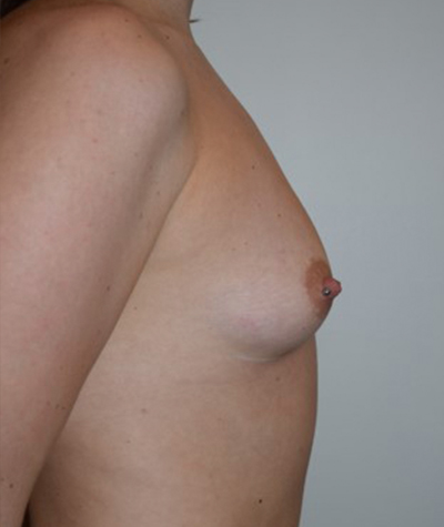 Breast Augmentation Before and After 28