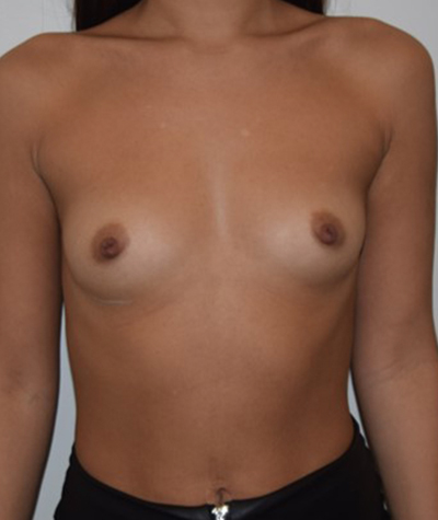 Breast Augmentation Before and After 30
