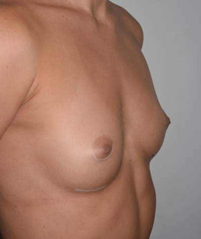 Breast Augmentation Before and After 31