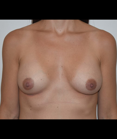 Breast Augmentation Before and After 31