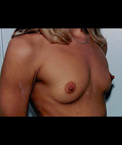 Breast Augmentation Before and After 35