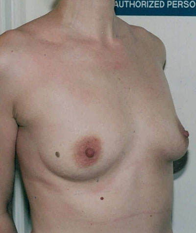 Breast Augmentation Before and After 37