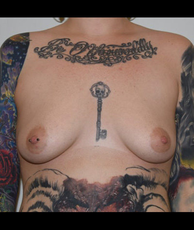 Breast Augmentation Before and After 39