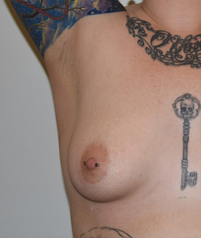 Breast Augmentation Before and After 39