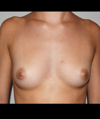 Breast Augmentation Before and After 41