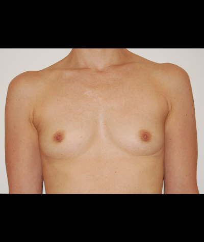 Breast Augmentation Before and After 43