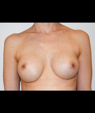 Breast Augmentation Before and After 31