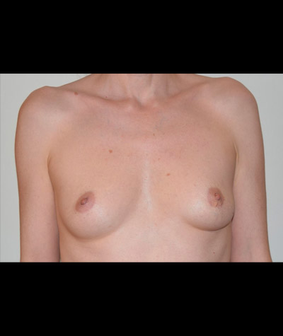 Breast Augmentation Before and After 44