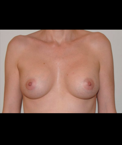 Breast Augmentation Before and After 31