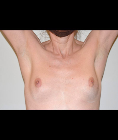 Breast Augmentation Before and After 44