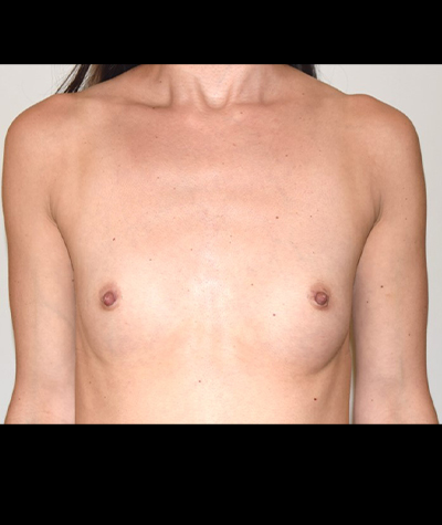 Breast Augmentation Before and After 45
