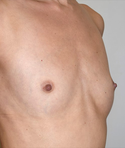 Breast Augmentation Before and After 45